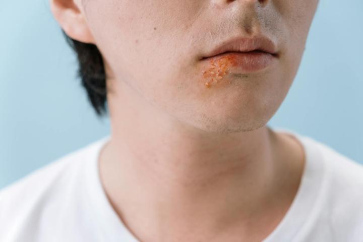 Impetigo u dětí: jak ho poznat, jak se léčí a proč se tak rychle šíří