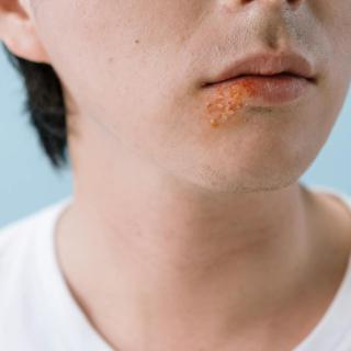Impetigo u dětí: jak ho poznat, jak se léčí a proč se tak rychle šíří